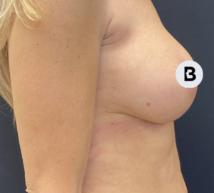 Breast Augmentation Before and After Pictures Buffalo, NY