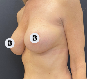 Breast Augmentation Before and After Pictures Buffalo, NY