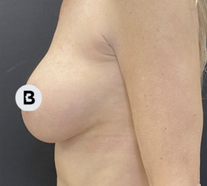 Breast Augmentation Before and After Pictures Buffalo, NY