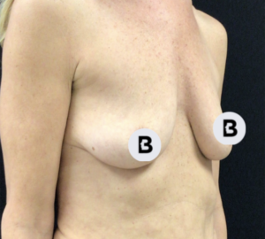 Breast Augmentation Before and After Pictures Buffalo, NY