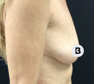 Breast Augmentation Before and After Pictures Buffalo, NY
