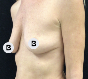 Breast Augmentation Before and After Pictures Buffalo, NY