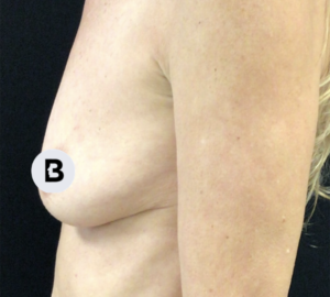 Breast Augmentation Before and After Pictures Buffalo, NY