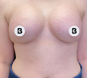 Breast Augmentation Before and After Pictures Buffalo, NY