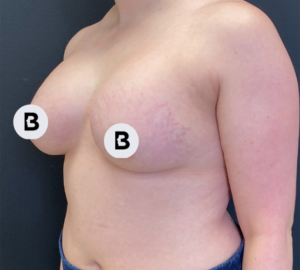 Breast Augmentation Before and After Pictures Buffalo, NY