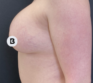 Breast Augmentation Before and After Pictures Buffalo, NY