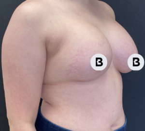 Breast Augmentation Before and After Pictures Buffalo, NY