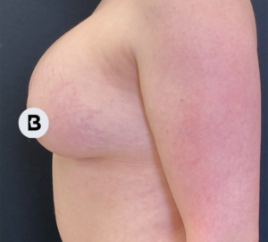 Breast Augmentation Before and After Pictures Buffalo, NY