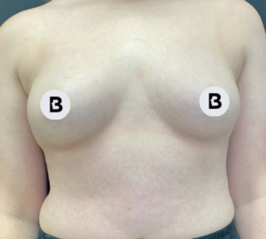 Breast Augmentation Before and After Pictures Buffalo, NY
