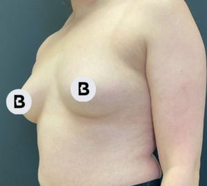 Breast Augmentation Before and After Pictures Buffalo, NY