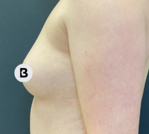 Breast Augmentation Before and After Pictures Buffalo, NY