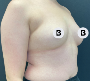 Breast Augmentation Before and After Pictures Buffalo, NY