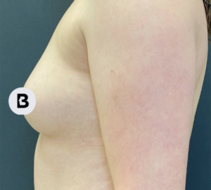 Breast Augmentation Before and After Pictures Buffalo, NY