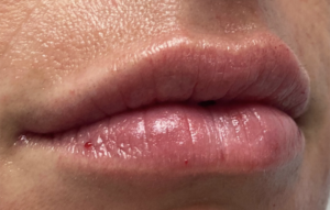 Lip Fillers Before and After Pictures Buffalo, NY