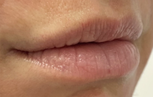 Lip Fillers Before and After Pictures Buffalo, NY