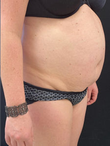 Abdominoplasty (Tummy Tuck) Before and After Pictures in Buffalo, NY