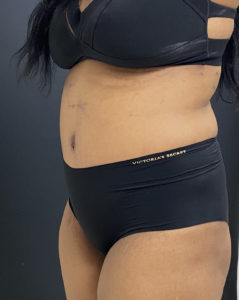 Abdominoplasty (Tummy Tuck) Before and After Pictures Buffalo, NY