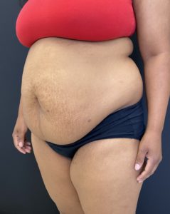 Abdominoplasty (Tummy Tuck) Before and After Pictures Buffalo, NY
