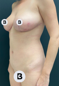Liposuction Before and After Pictures in Buffalo, NY