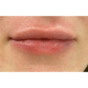 Lip Fillers Before and After Pictures Buffalo, NY