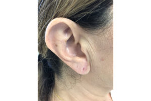 Fillers Before and After Pictures Buffalo, NY
