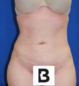 Liposuction Before and After Pictures Buffalo, NY