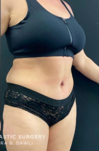 Breast Augmentation Before and After Pictures in Buffalo, NY