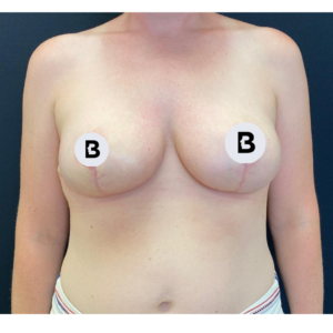 Breast Reduction Before and After Pictures Buffalo, NY