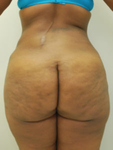 Brazilian Butt Lift Before and After Pictures Buffalo, NY