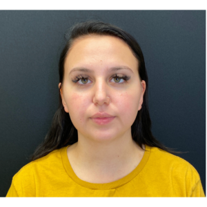 Chin Liposuction Before and After Pictures Buffalo, NY