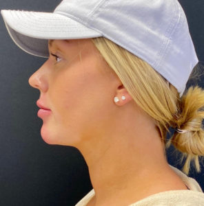 Chin Fillers Before and After Pictures Buffalo, NY