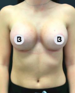Breast Augmentation Before and After Pictures Buffalo, NY