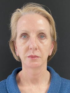 Facelift Before and After Pictures in Buffalo, NY