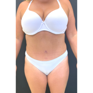 Abdominoplasty (Tummy Tuck) Before and After Pictures Buffalo, NY