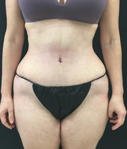 Abdominoplasty (Tummy Tuck) Before and After Pictures Buffalo, NY