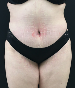Abdominoplasty (Tummy Tuck) Before and After Pictures Buffalo, NY
