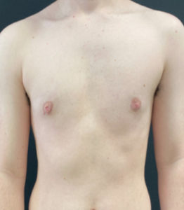 Female to Male Top Surgery Before and After Pictures Buffalo, NY