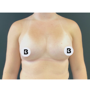 Breast Augmentation Before and After Pictures Buffalo, NY