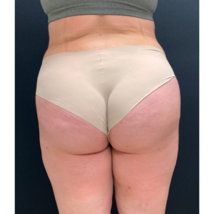 Brazilian Butt Lift Before and After Pictures Buffalo, NY