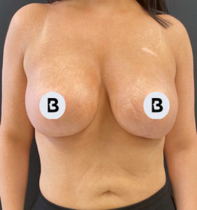 Breast Augmentation Before and After Pictures Buffalo, NY