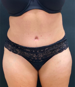 Abdominoplasty (Tummy Tuck) Before and After Pictures Buffalo, NY