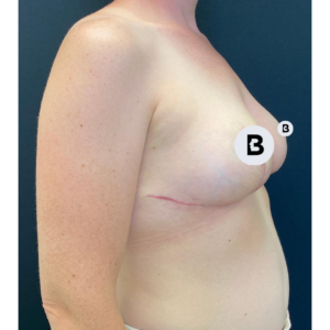 Breast Reduction Before and After Pictures Buffalo, NY