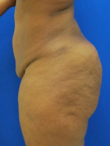 Brazilian Butt Lift Before and After Pictures Buffalo, NY