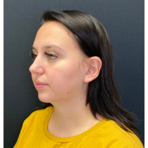 Chin Liposuction Before and After Pictures Buffalo, NY