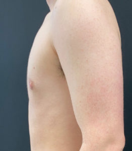 Female to Male Top Surgery Before and After Pictures Buffalo, NY