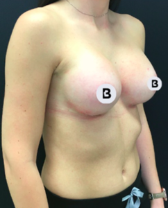 Breast Augmentation Before and After Pictures Buffalo, NY