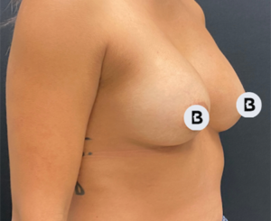 Breast Augmentation Before and After Pictures Buffalo, NY