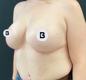 Mastopexy (Breast Lift) Before and After Pictures in Buffalo, NY