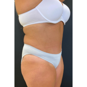 Abdominoplasty (Tummy Tuck) Before and After Pictures Buffalo, NY