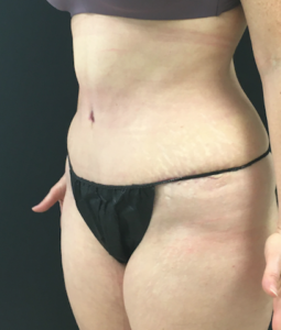 Abdominoplasty (Tummy Tuck) Before and After Pictures Buffalo, NY